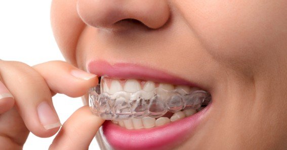 A Guide to the Various Types of Braces for a Beautiful Smile