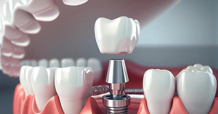 understanding the investment3A all on 4 dental implants cost breakdown